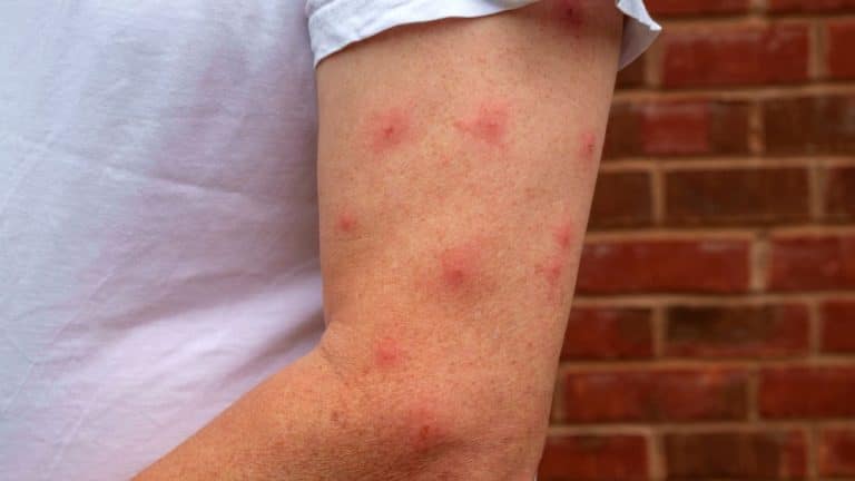 Les bons gestes à adopter pour ne pas avoir de piqures de moustiques cet été