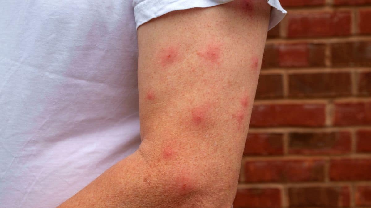 Les bons gestes à adopter pour ne pas avoir de piqures de moustiques cet été
