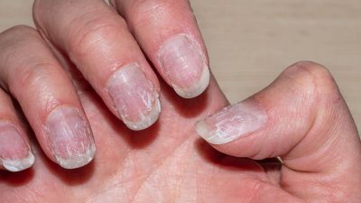 Si vous avez les ongles rayés il faut tout de suite consulter un docteur