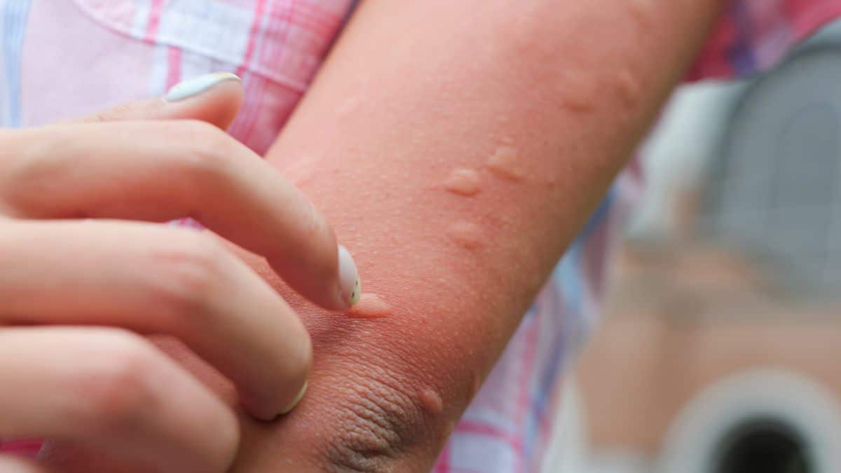 Attention à la piqûre de cet insecte cet été, elle est encore plus dangereuse que celle du moustique et de la guêpe