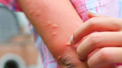 « Ça brûle mais ce n’est pas une guêpe » : l’insecte méconnu qui pique en terrasse et sur le balcon