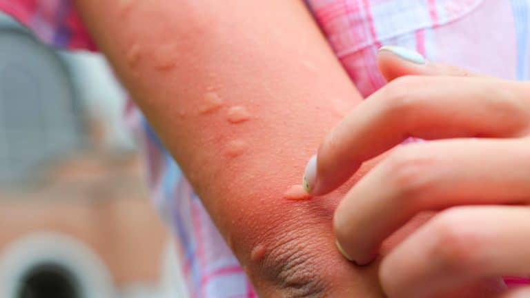 « Ça brûle mais ce n’est pas une guêpe » : l’insecte méconnu qui pique en terrasse et sur le balcon
